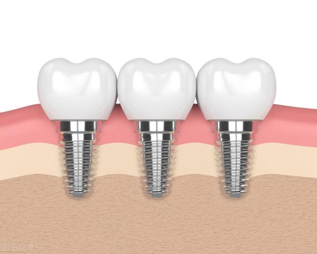 种植的牙齿松动了，拔掉后还可以再种植吗？