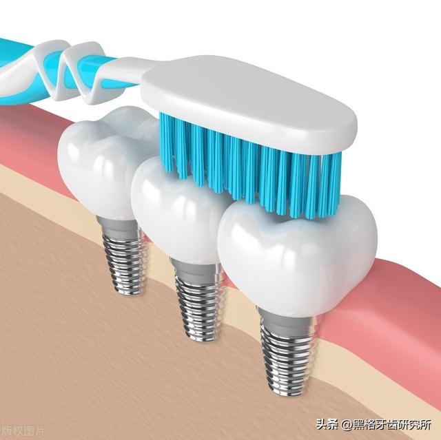 种植牙的寿命有多少年？能用一辈子吗？种牙后，这3件事要做对！