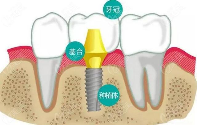 【杏林微科普】种植牙——人类的第三副牙齿