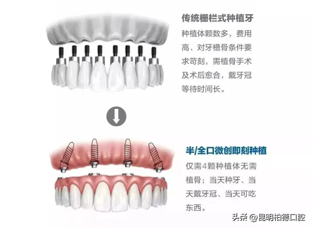 拔完牙齿后多久能种牙？种植医生：5种情况要注意