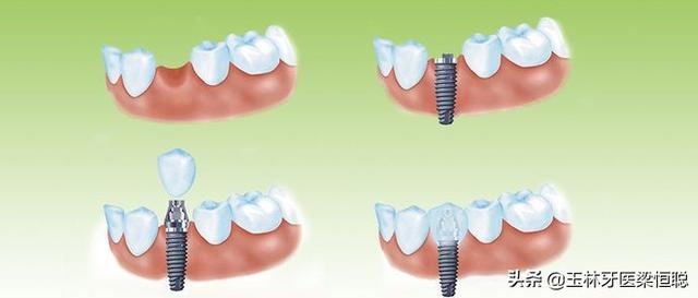 种植牙知识全面解答