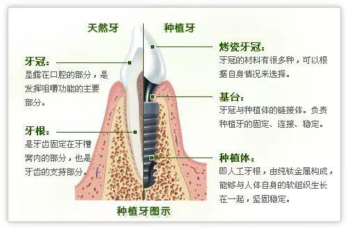 种植牙可以用一辈子吗？