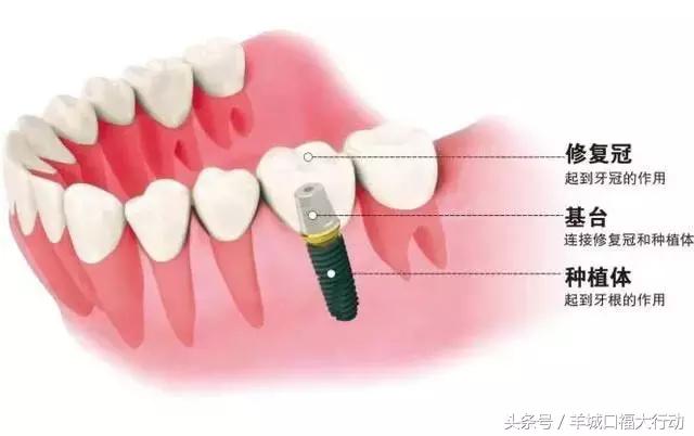 做种植牙有危害吗