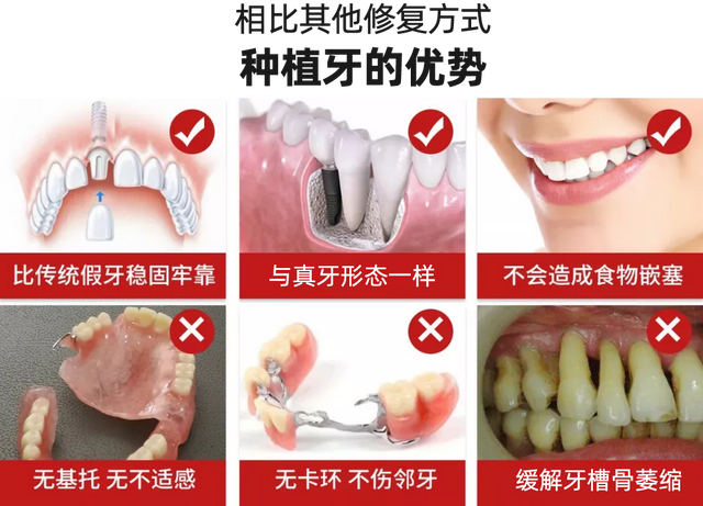 成都又一新政策落地，进集采、纳医保，2800种植牙包干价！