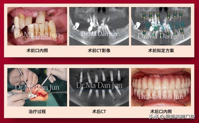 拔完牙齿后多久能种牙？种植医生：5种情况要注意