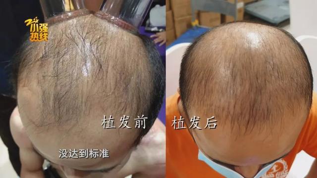 男子去植发，15元1根，付款时惊呆了：根本还不起……