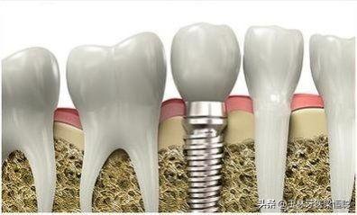 种植牙知识全面解答