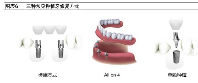 牙科医疗专题报告：种植牙深度研究