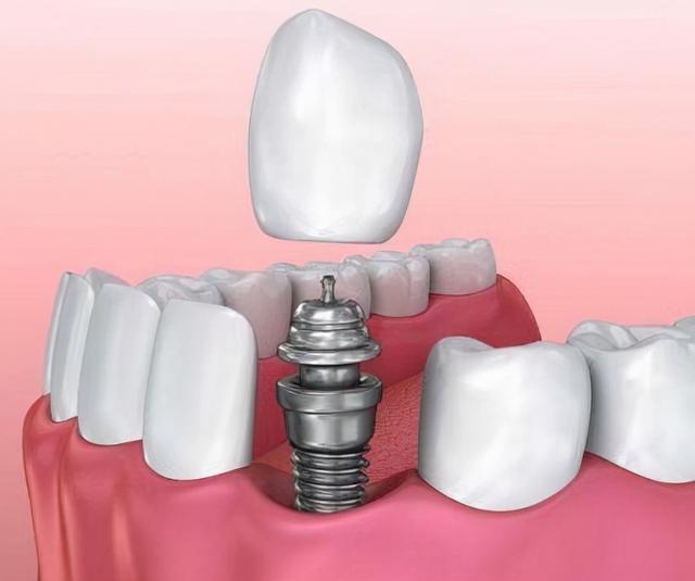 有严重牙槽骨萎缩，不愿意接受植骨手术！直接种牙有什么后果？
