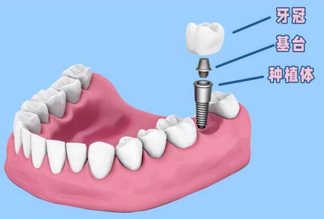 「牙齿那些事儿」No.14丨种植牙就是固定假牙吗？有什么区别