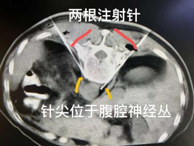 腹腔淋巴结继发恶性肿瘤治疗——腹膜后淋巴结转移