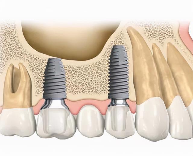 有严重牙槽骨萎缩，不愿意接受植骨手术！直接种牙有什么后果？