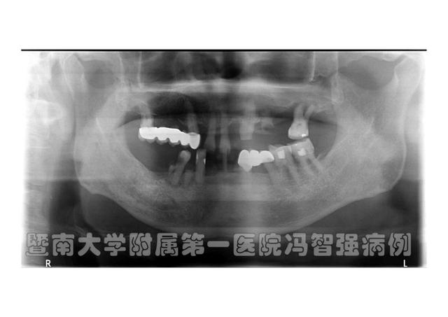 多病缠身的帕金森患者也能种牙？精准种植使八旬老人重获好牙