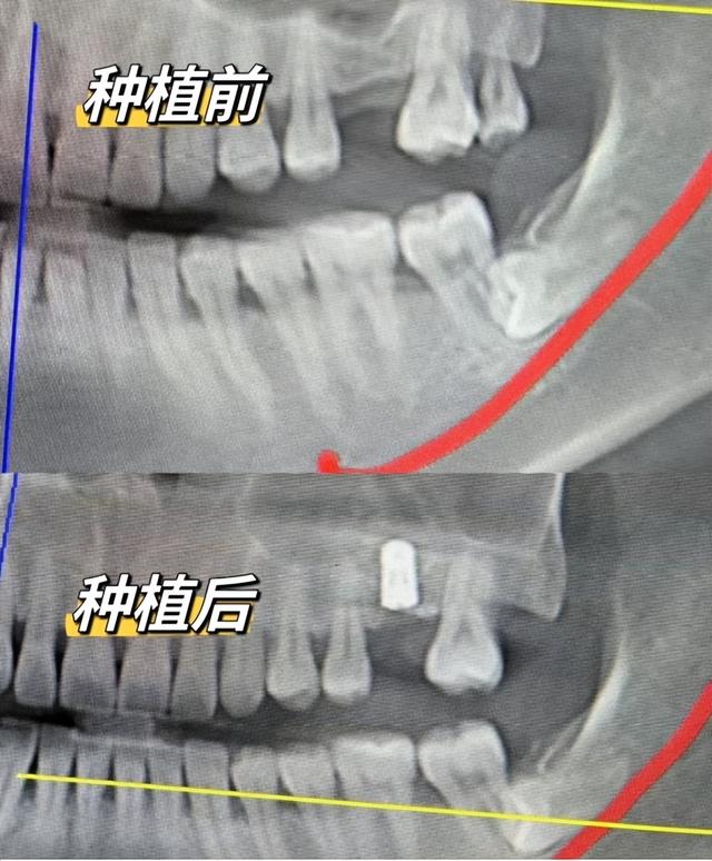 种植牙四年老司机，提醒大家远离口腔护理危害误区！