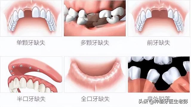 缺牙多少年还能种牙吗？哪些人适合做种植牙？