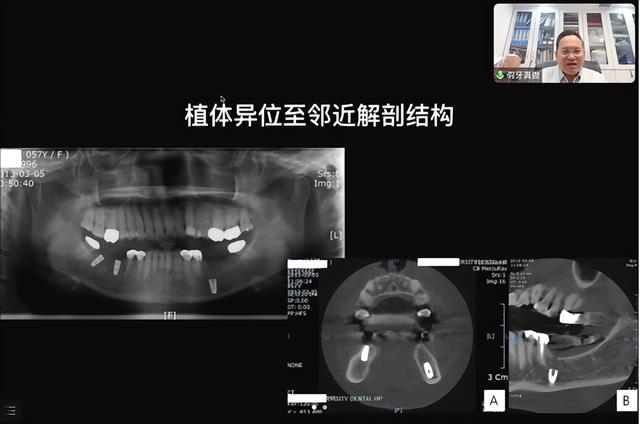 《口腔种植空间维持技术新进展》国家级继教班举行