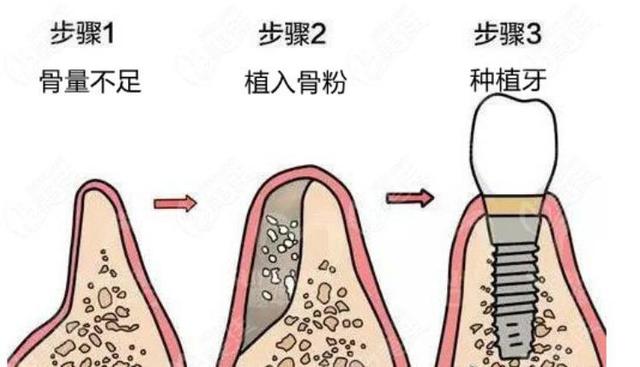 深圳种植牙降价多少？中山七院专家解答种植牙热点问题