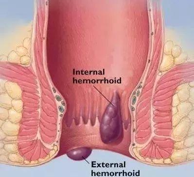 介入微创治痔疮——有“痔”之士好福气