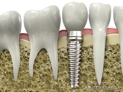 你不了解的“种植牙”全在这里了