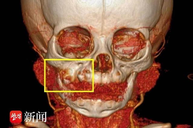 医生取腓骨“移花接木”，为6月龄骨肿瘤宝宝重建上颌骨