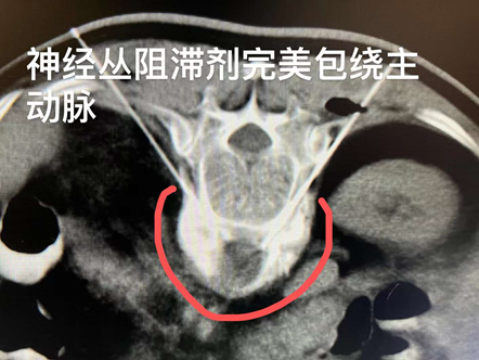 腹腔淋巴结继发恶性肿瘤治疗——腹膜后淋巴结转移