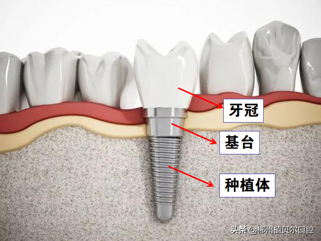 现在最流行的种植牙，多少钱一颗，到底靠谱吗？