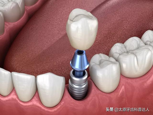 你不了解的“种植牙”全在这里了