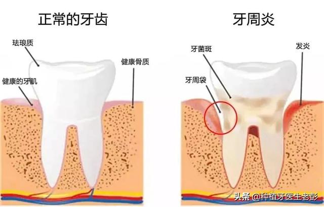 缺牙多少年还能种牙吗？哪些人适合做种植牙？