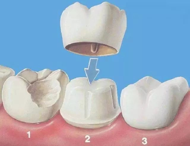 种牙好还是根管治疗好？