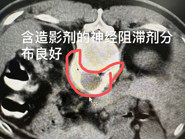 腹腔淋巴结继发恶性肿瘤治疗——腹膜后淋巴结转移