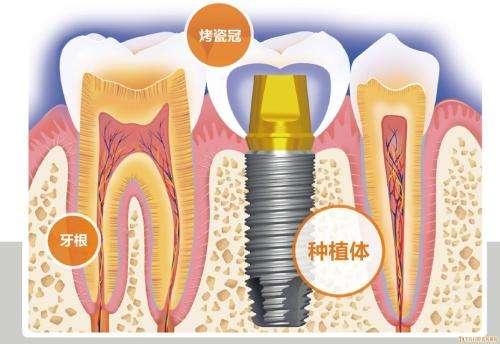 种植牙第一期：你不得不了解的那些事儿——植体断了怎么办？