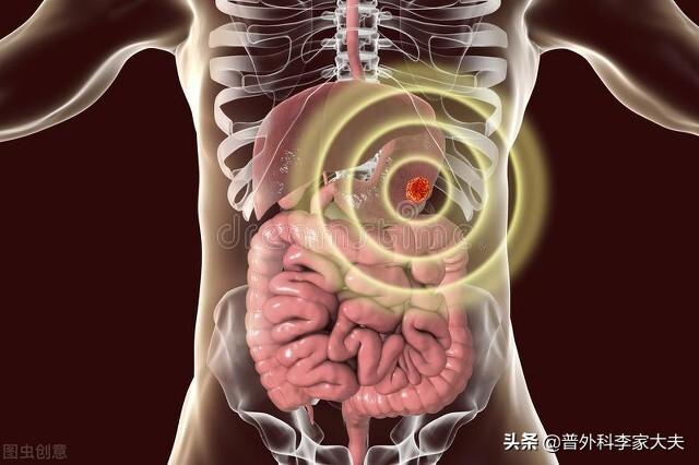 腹膜转移是导致进展期胃癌治疗失败的主要原因，如何早期诊断它