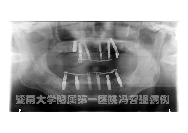 多病缠身的帕金森患者也能种牙？精准种植使八旬老人重获好牙