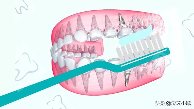战“疫”护牙：“坐困家中”，谁来救救我的种植牙？
