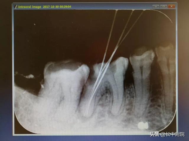 【科普】口腔中心告诉您根管治疗是怎么一回事