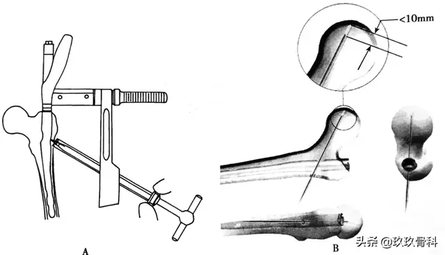 骨科常用的髓内钉，技术要点看这里