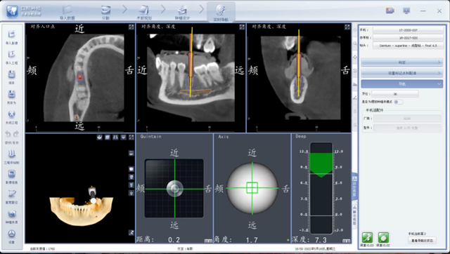 「新技术」南昌大学附属口腔医院完成首例数字化实时导航种植手术