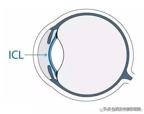 我们说说“高大上”的近视手术——ICL手术的相关问题