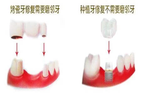 种植牙与烤瓷牙区别在哪？哪种缺牙修复方式更好？医师教您选择