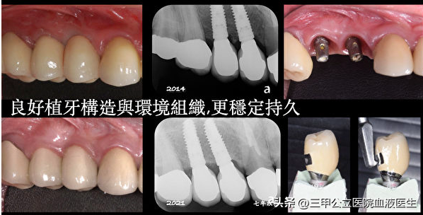 口腔医生绝对不会告诉你种植牙过程中的几点“秘密”