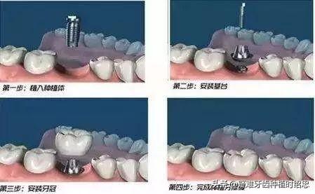 「科普」如果想做种植牙，现在开始要准备些什么？