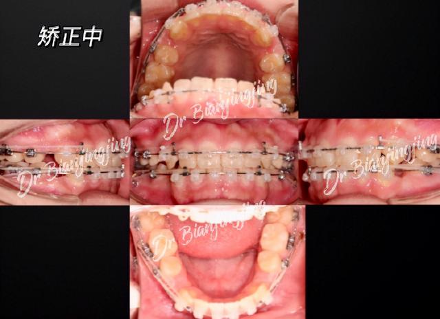 陶瓷自锁案例｜单纯正畸解决双颌前突