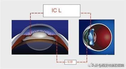 我们说说“高大上”的近视手术——ICL手术的相关问题