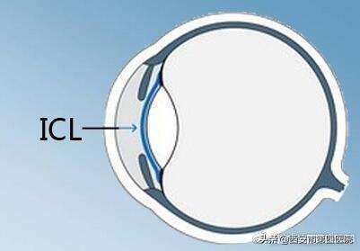 我们说说“高大上”的近视手术——ICL手术的相关问题