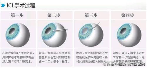 我们说说“高大上”的近视手术——ICL手术的相关问题