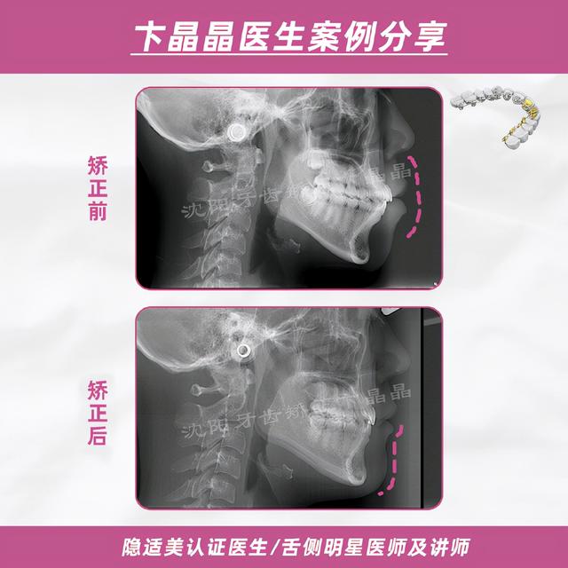 陶瓷自锁案例｜单纯正畸解决双颌前突