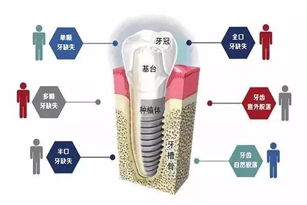 种植牙要几次手术才能完成？具体过程是怎样的？牙科医生为你揭秘