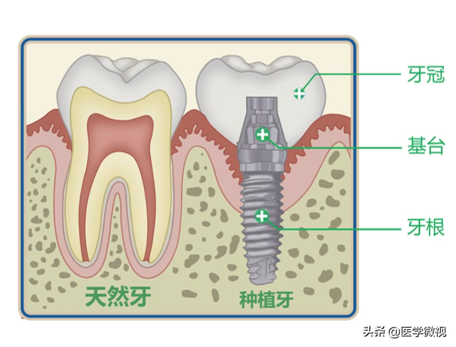 全瓷、金属、烤瓷？种植牙的材料，该如何选？