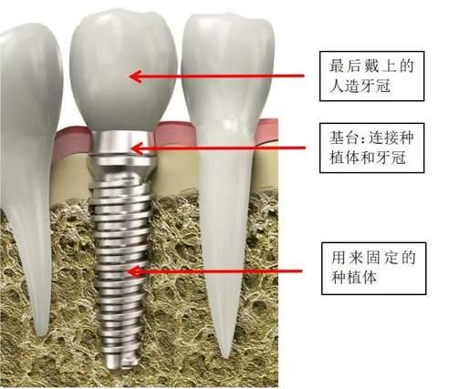 种牙集采预计降幅达八成，300亿市场暴利几何？