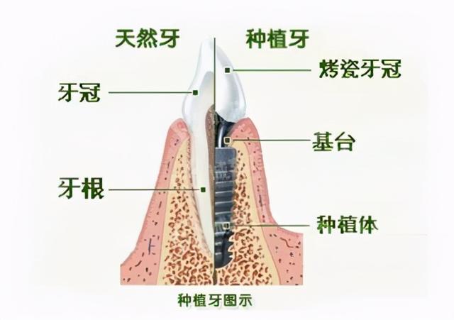 植入到口腔内的“螺丝”真的会生锈吗？看看专家怎么说